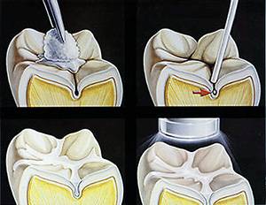 Dental sealant