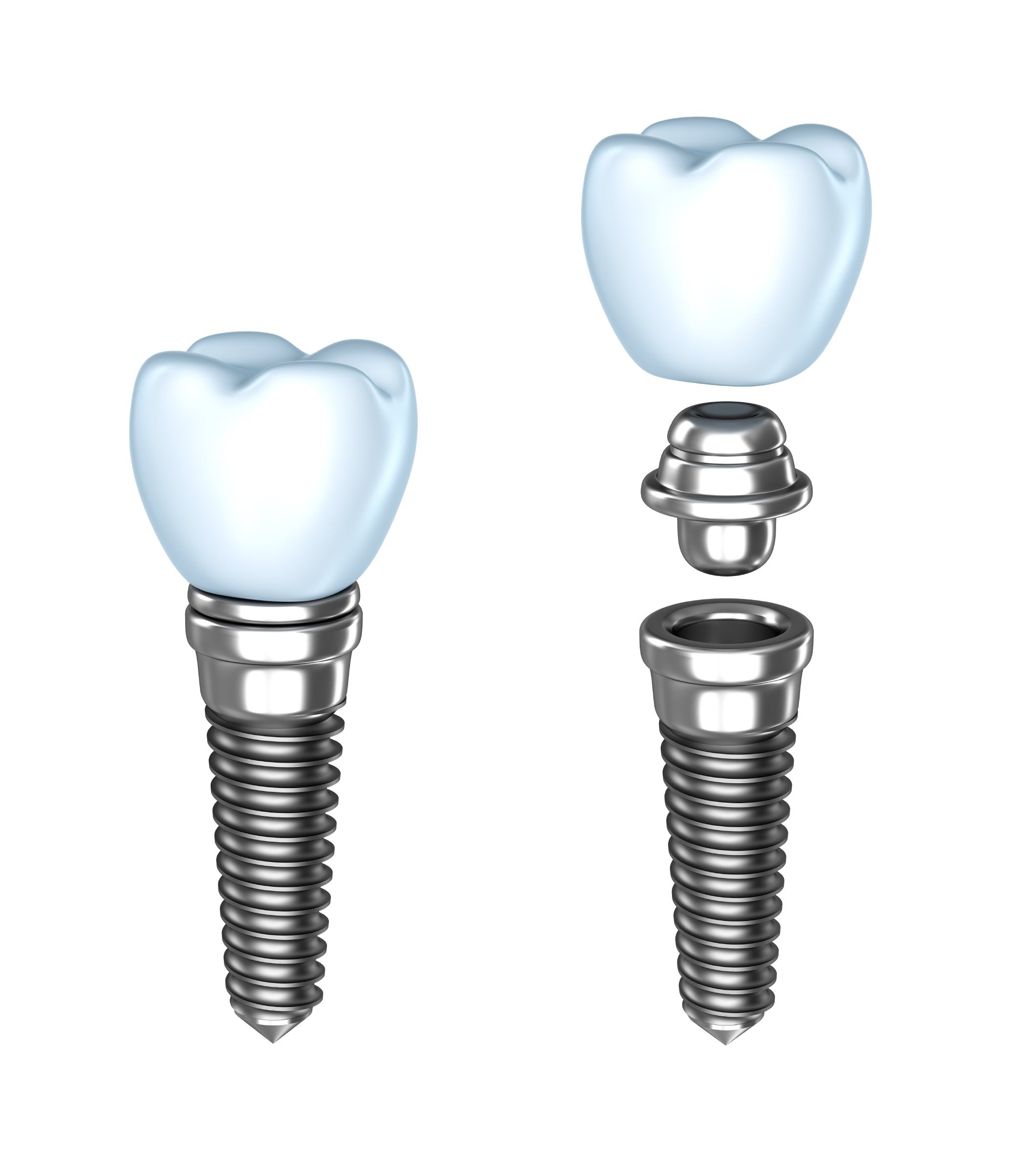 methode implant dentaire 2